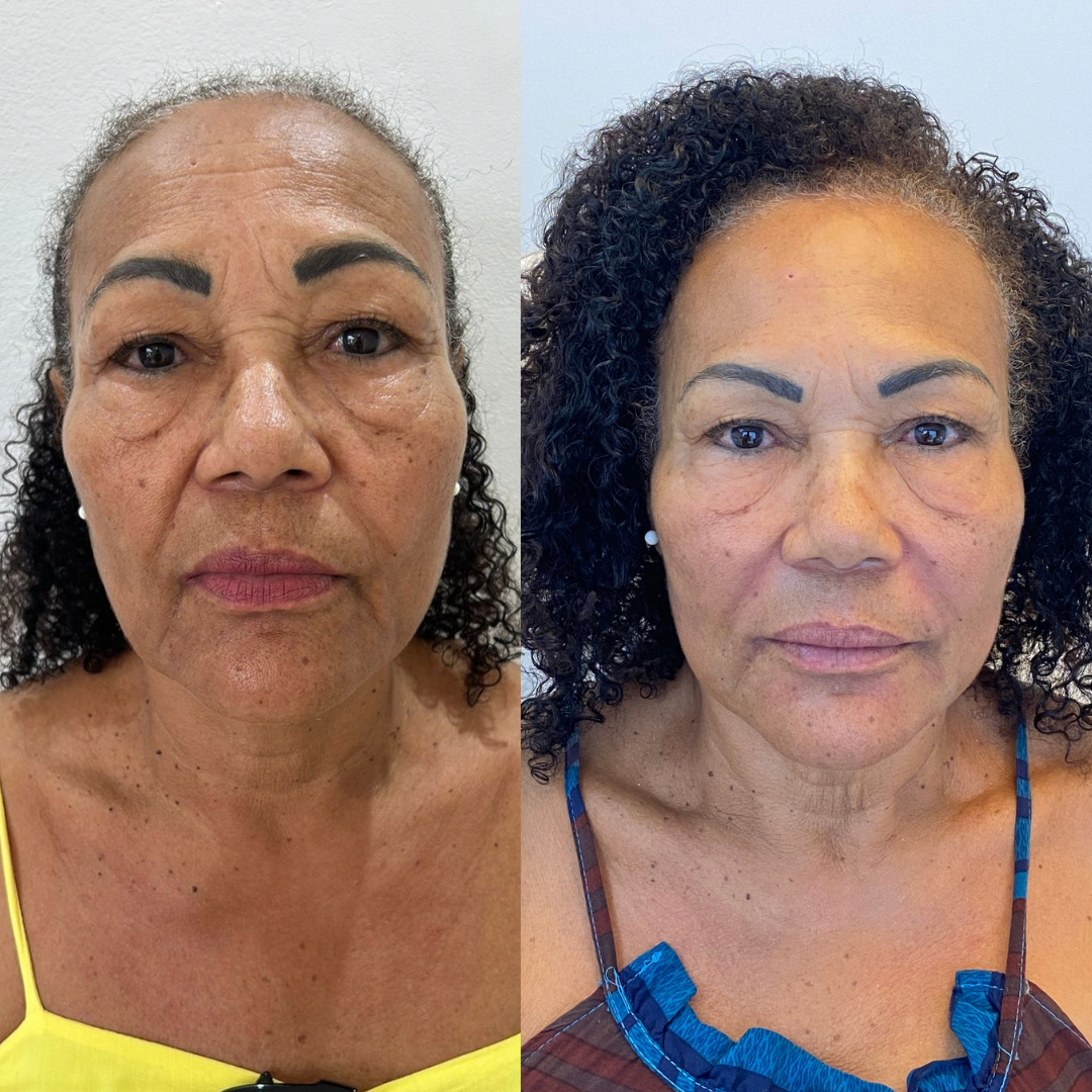 Beige-Minimalist-Skincare-Before-and-After-Instagram-Post-2.png