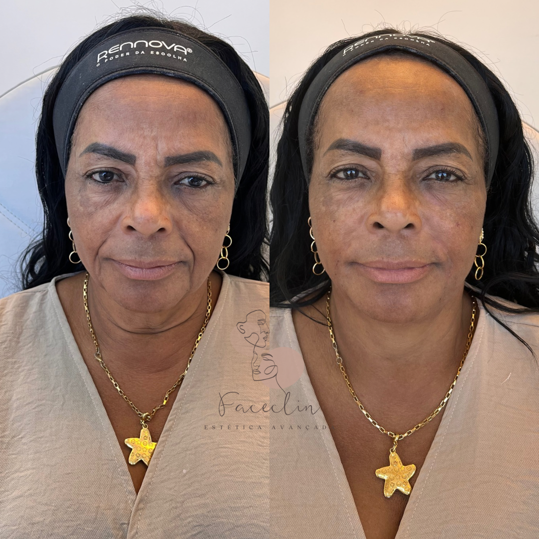 Beige-Minimalist-Skincare-Before-and-After-Instagram-Post.png